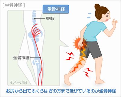 座骨神経痛（症状）＝お尻裏側～大腿～足先に走るしびれ